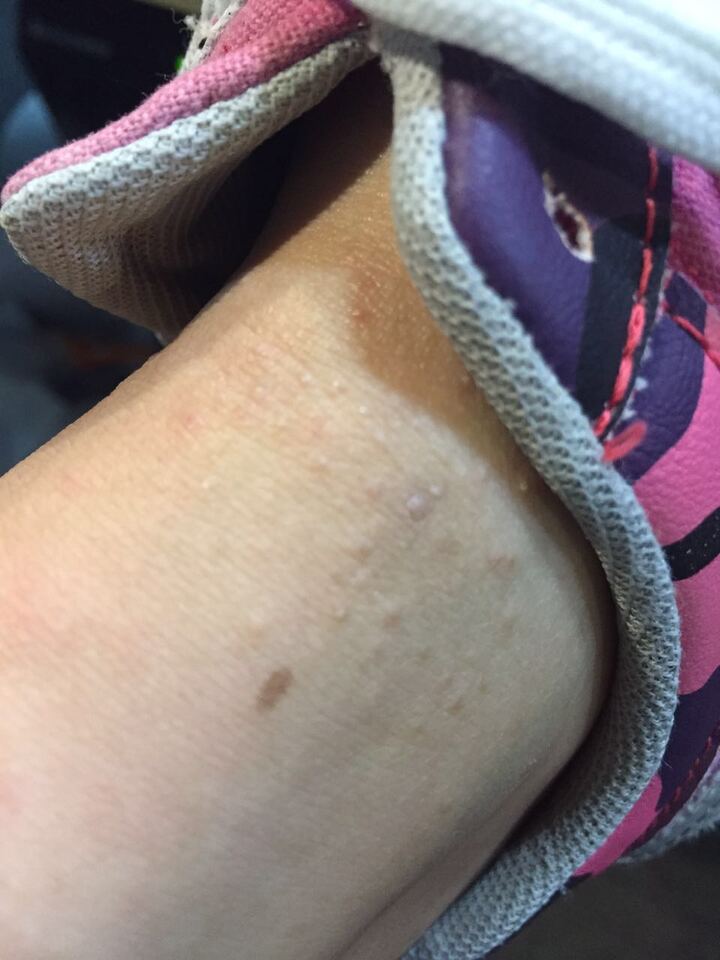 请问下,谁知道这样的痘痘是什么情况,会痒,越抓越痒,而且还红,犯白头