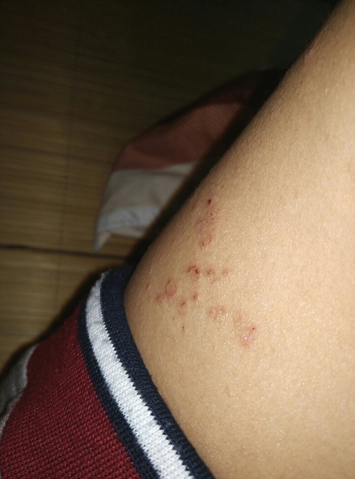 去到开暖气的地方就更痒了 一挠它就在周边越多!现在 大腿内侧 手臂