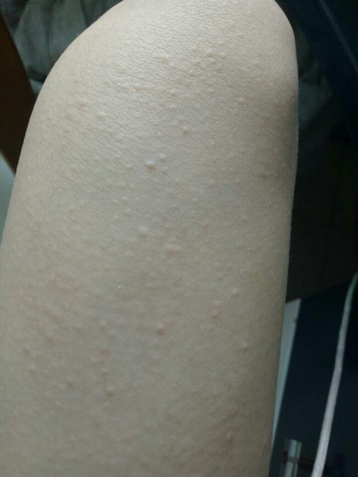 大腿上很痒,用手挠一挠就出现一大堆疙瘩,越挠越痒
